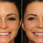 Before After Smile Makeover 3