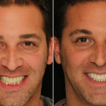 Before After Smile Makeover 2